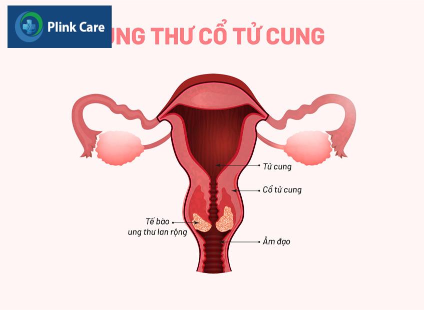 có liên quan đến ung thư cổ tử cung