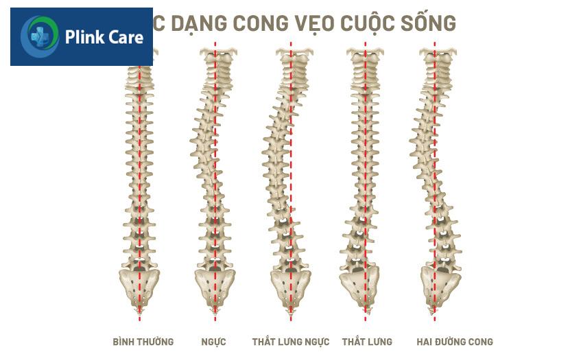 cột sống có nhiều dạng cong vẹo khác nhau