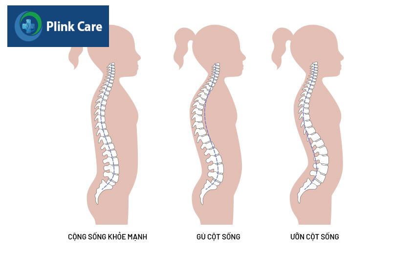 gù cột sống ở trẻ em