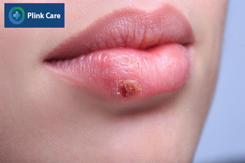 herpes sinh dục có lây không