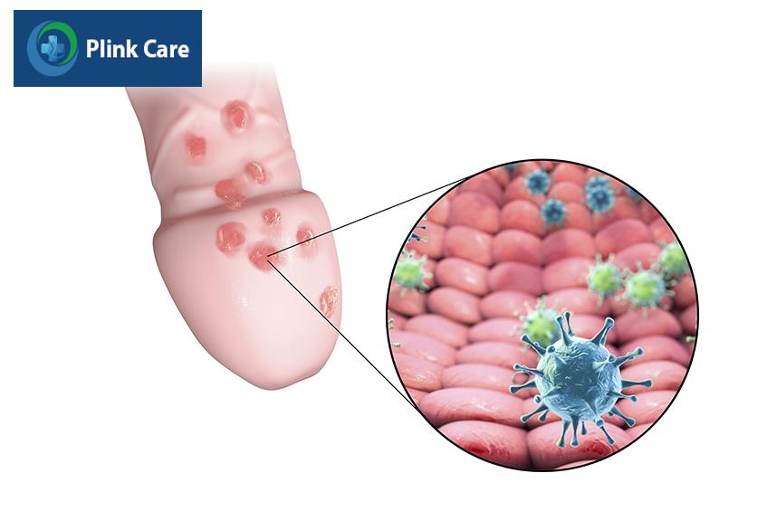 herpes sinh dục là gì