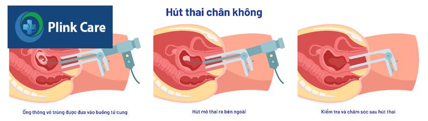 mô tả phương pháp hút thai chân không