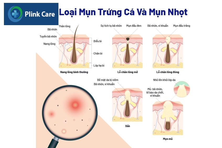 mụn ẩn là gì