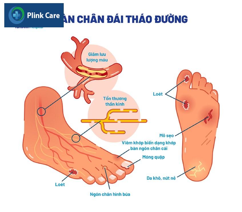 Người bệnh đái tháo đường thường xuyên kiểm tra bàn chân