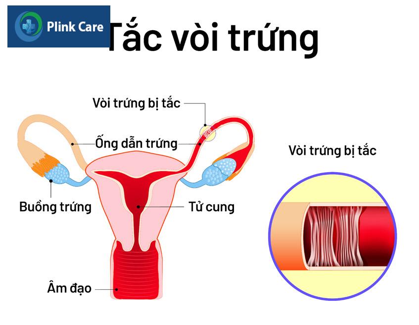 nguyên nhân do tắc vòi trứng