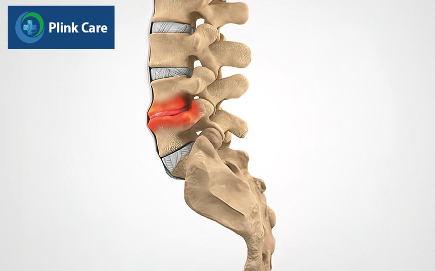 tình trạng bị mất nước ở đĩa đệm