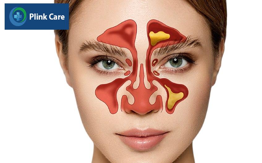 triệu chứng viêm xoang bướm