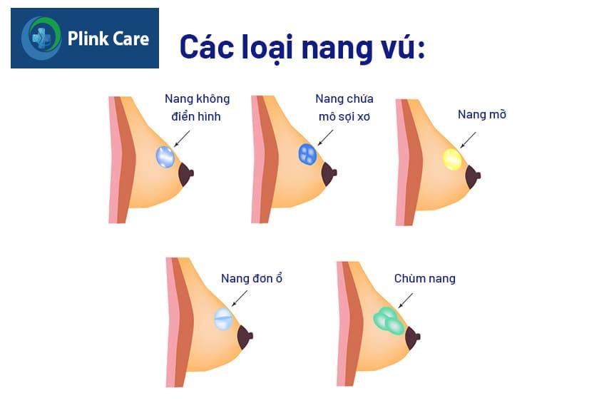 các loại nang vú