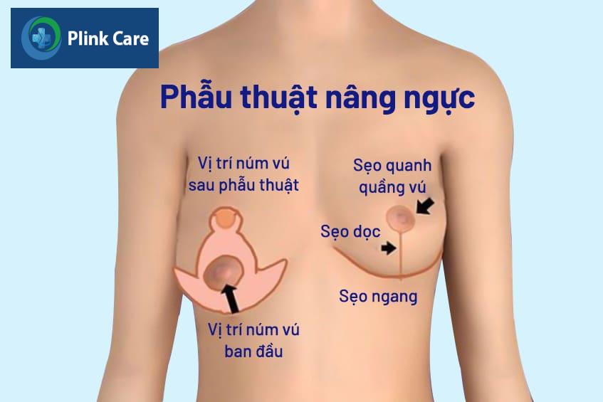 Các phương pháp nâng ngực chảy xệ hiện nay