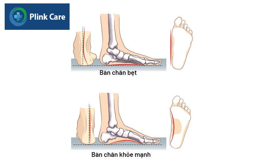 cách nhận biết bàn chân bẹt ở trẻ em