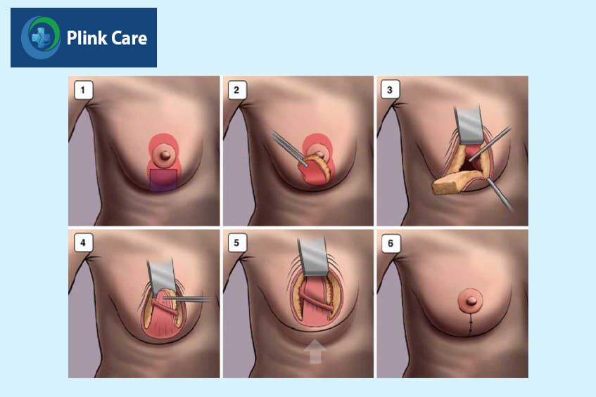 Chăm sóc sau phẫu thuật nâng ngực chảy xệ