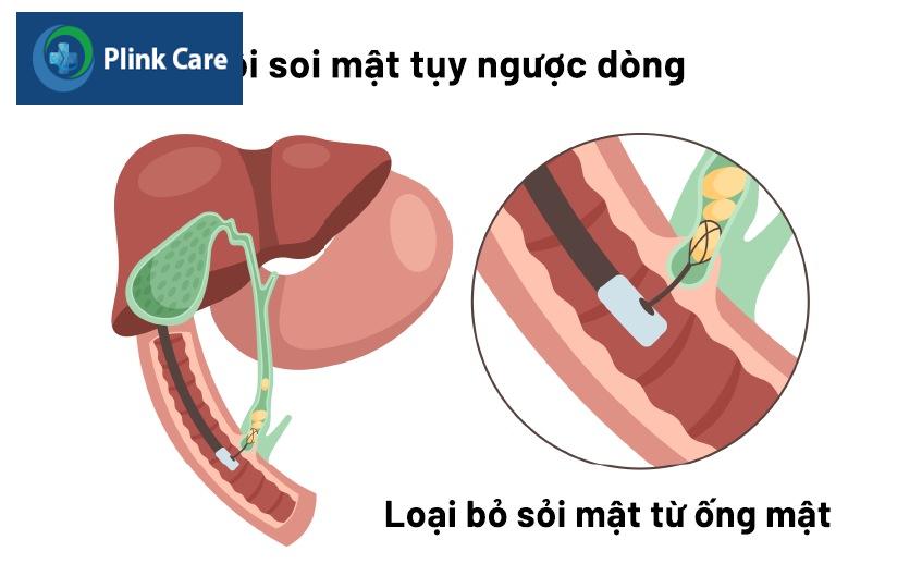 chẩn đoán sỏi ống mật chủ
