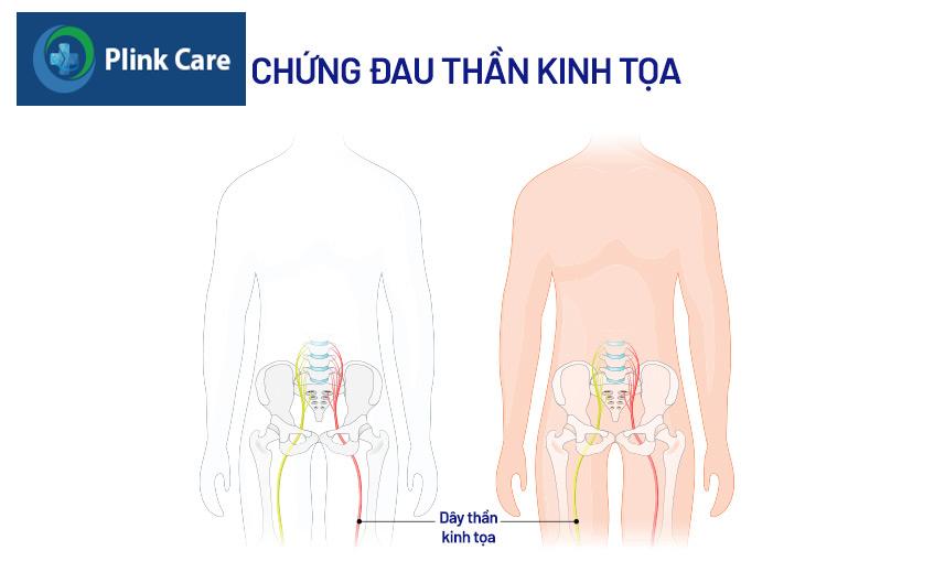 chứng đau dây thần kinh tọa