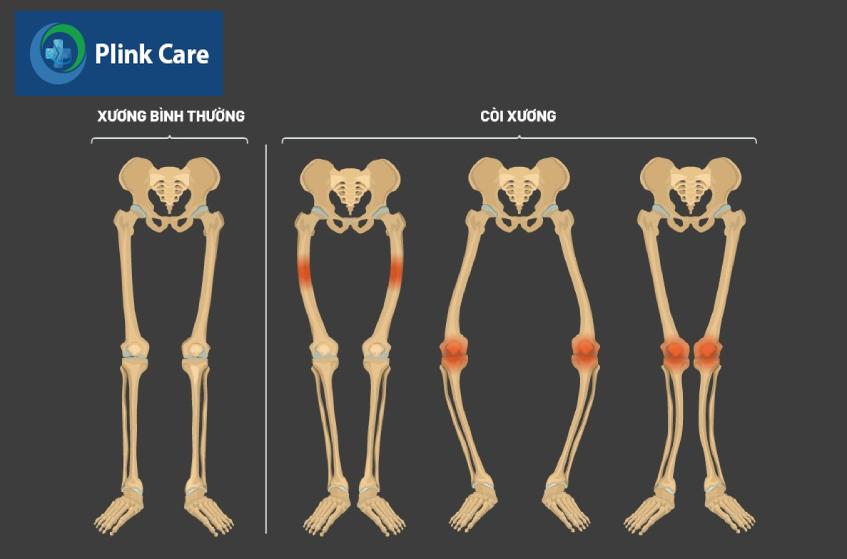 Còi xương gây biến dạng xương