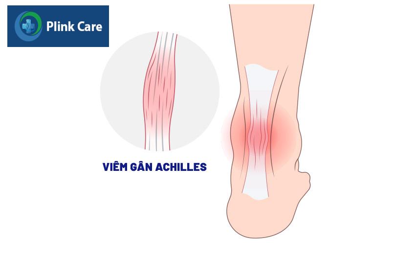dẫn đến tình trạng viêm gót chân achilles