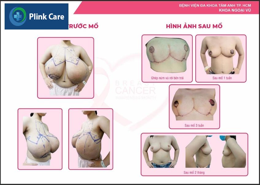 Điều trị chứng phì đại tuyến vú