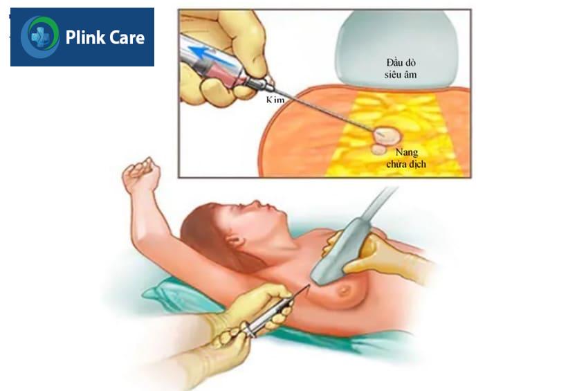 Điều trị thay đổi sợi bọc tuyến vú
