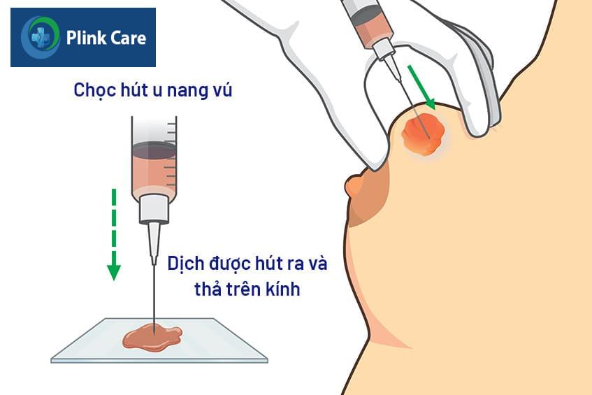 Điều trị u nang vú thế nào?