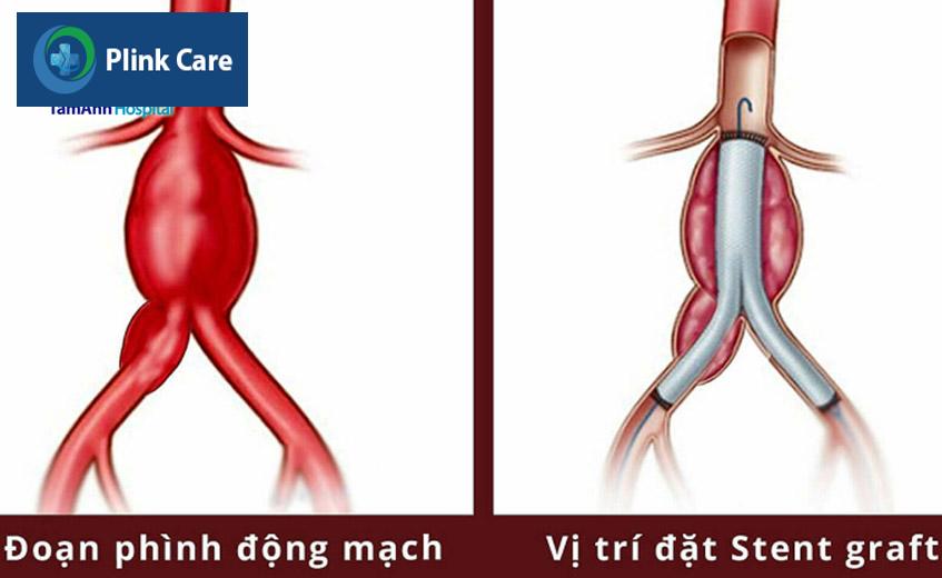 đoạn phình động mạch