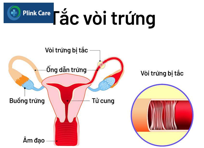 hiếm muộn nữ do tắc vòi trứng