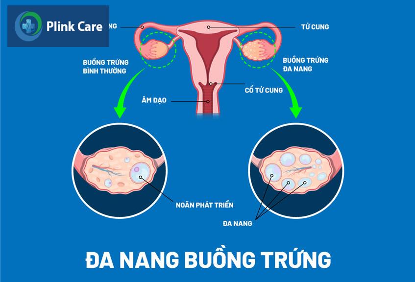 kháng isulin và béo phì gây đa nang buồng trứng