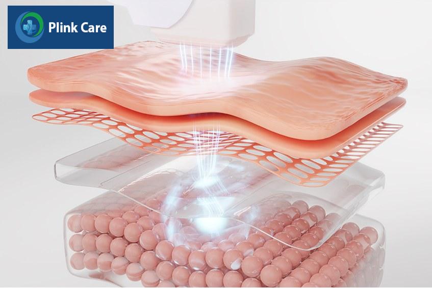laser tái tạo da là gì