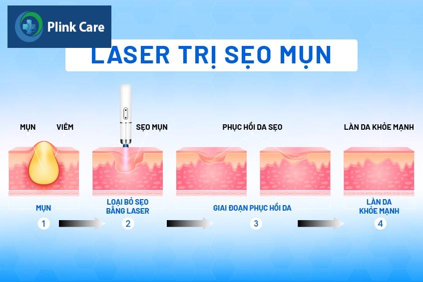 laser trị sẹo mụn