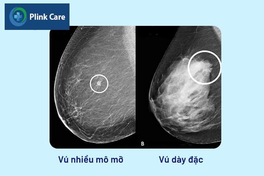 Mật độ mô vú dày ảnh hưởng thế nào?