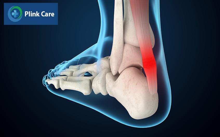 một số vấn đề ở gân gót chân