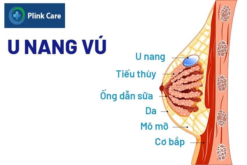 Nang vú là gì