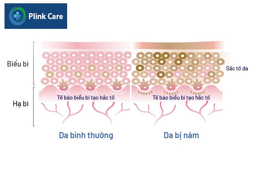phân biệt các loại nám da