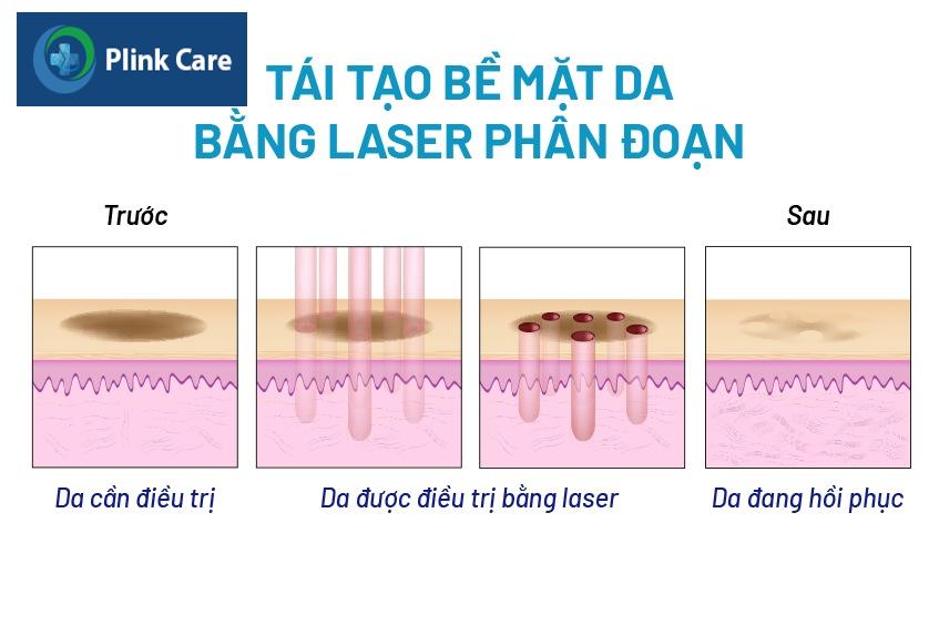quy trình Laser CO2 Fractional