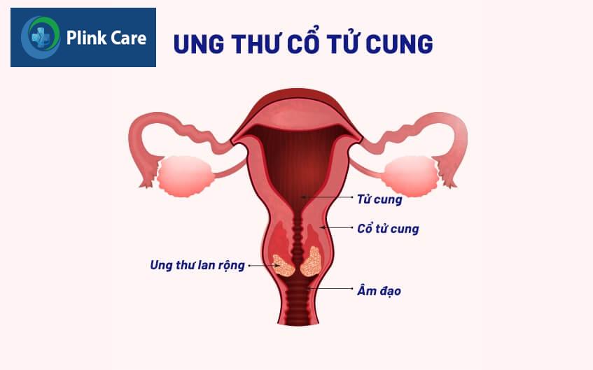 sàng lọc ung thư cổ tử cung