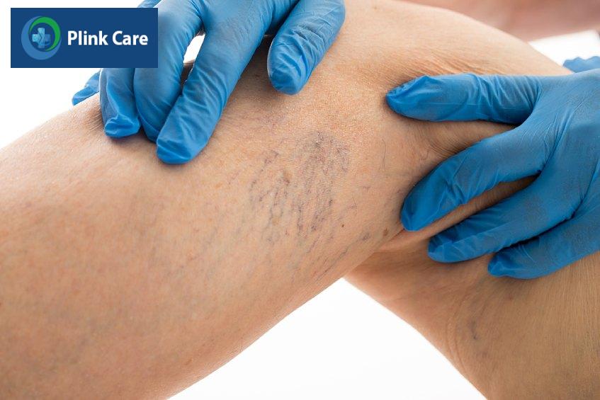 siêu âm mạch máu phát hiện bệnh gì