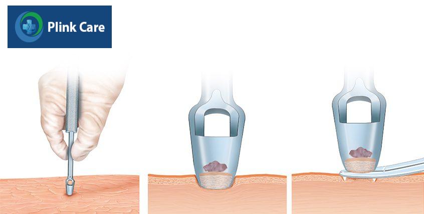 sinh thiết và chọc hút tủy xương