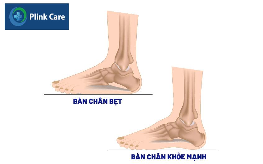 so sánh bàn chân bình thường và bàn chân bẹt