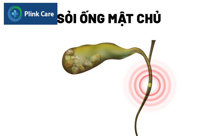 sỏi ống mật chủ là gì
