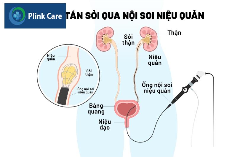 tán sỏi nội soi niệu quản