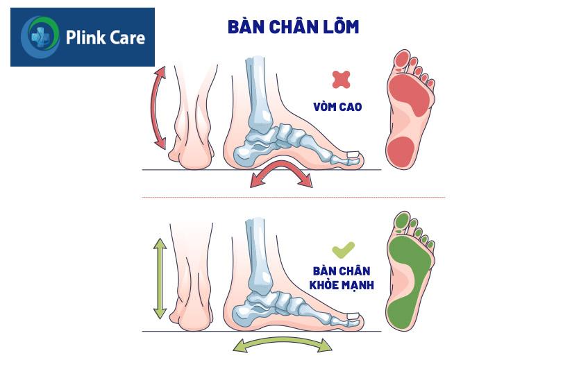 tình trạng bàn chân bị lõm sâu