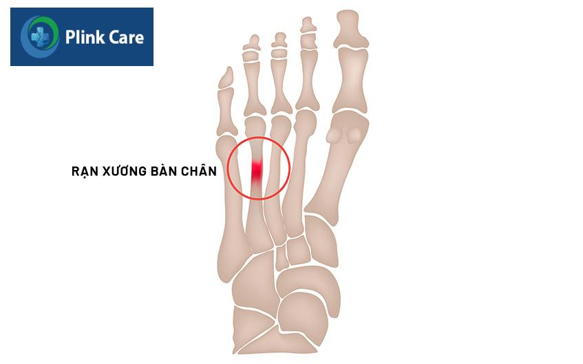 tình trạng xương bị rạn ở bàn chân