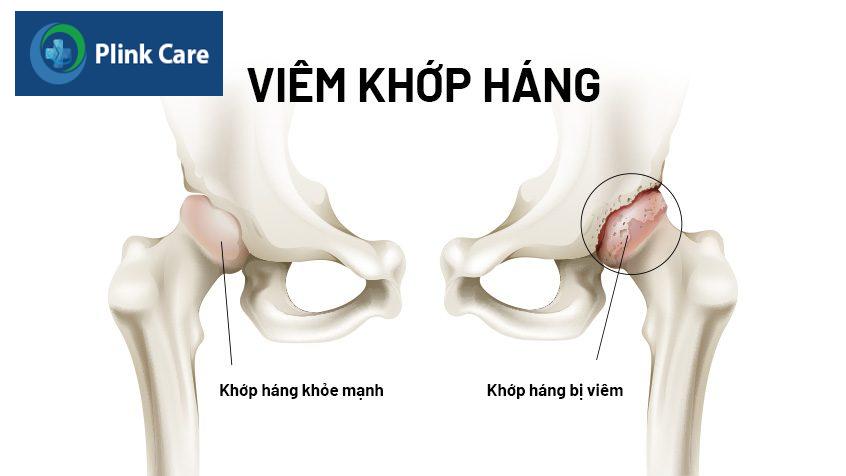 viêm khớp háng ở trẻ nhỏ