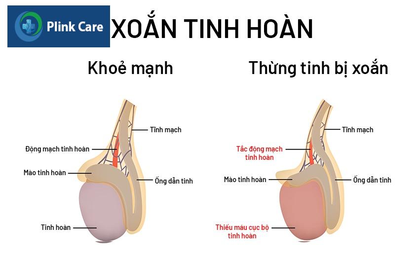 xoắn tinh hoàn ở trẻ là gì