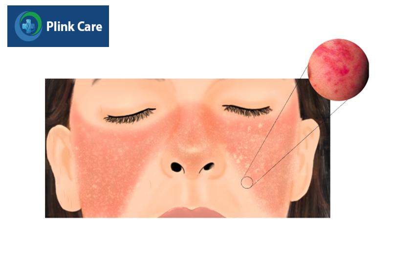 Người bệnh lupus có nguy cơ mắc hội chứng thận hư rất cao