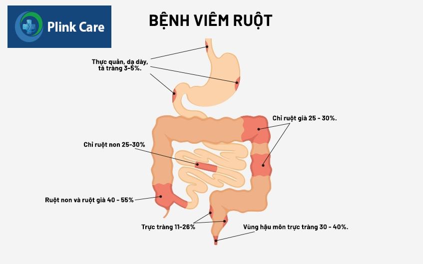 bệnh crohn là bệnh gì