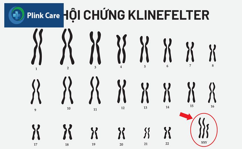 bệnh klinerfelter ở nam giới