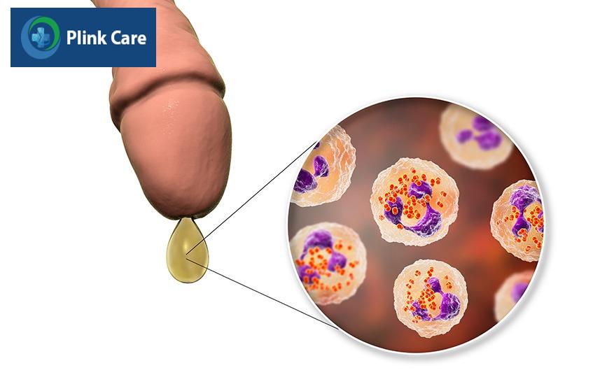 bệnh lậu có lây không