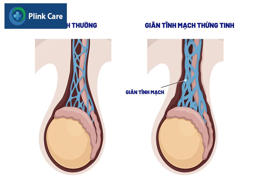 bị giãn tĩnh mạch thừng tinh