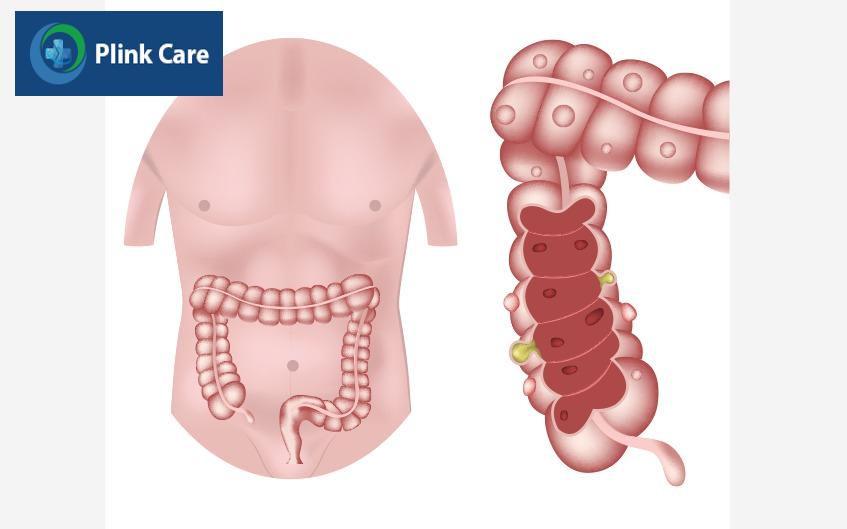 biến chứng bệnh crohn