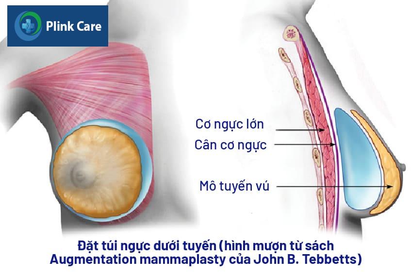 các vị trí đặt túi ngực