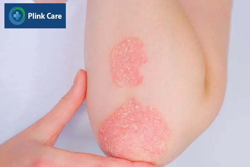 các cách điều trị vảy nến
